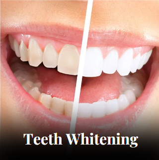 Teeth Whitening