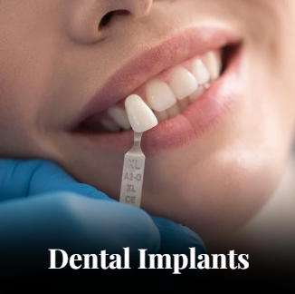 Dental Implants